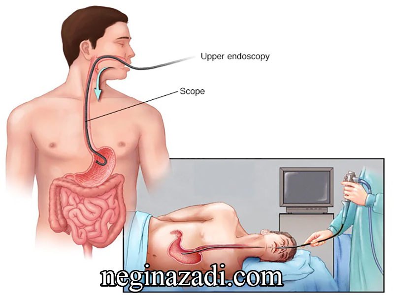آندوسکوپی معده