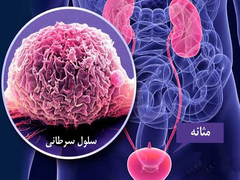 درمان قطعی سرطان مثانه