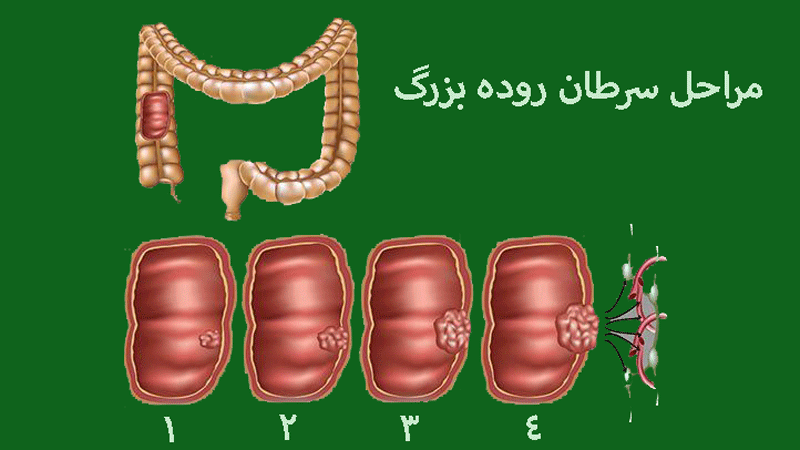 تصویر نشان دهنده سرطان روده بزرگ