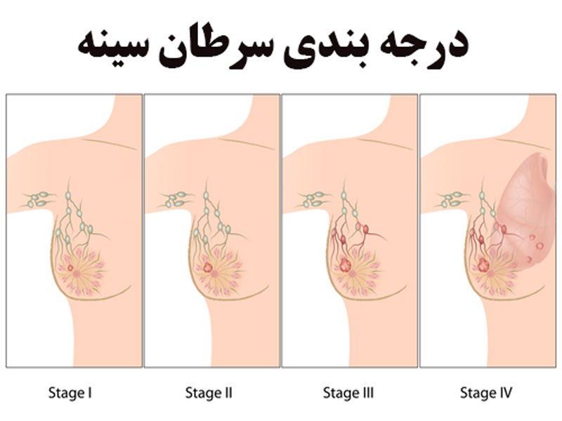 درجه بندی سرسان سینه