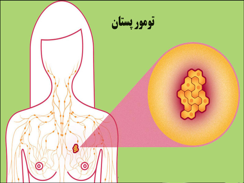 تومور سرطان سینه