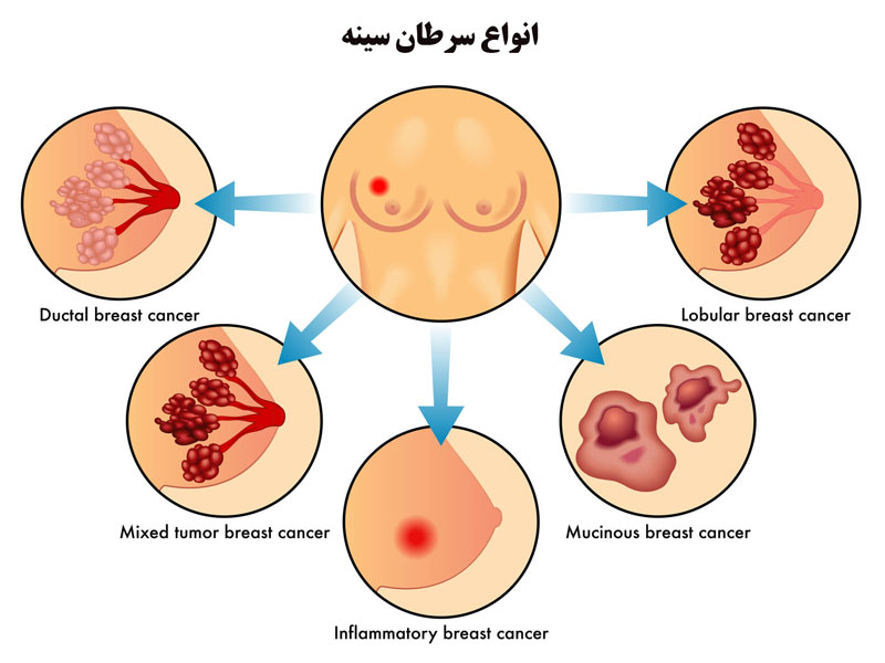 انواع سرطان سینه
